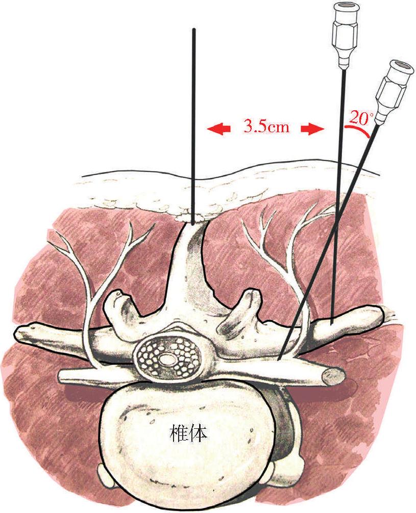 第六節(jié) 夾脊穴注射術(shù)